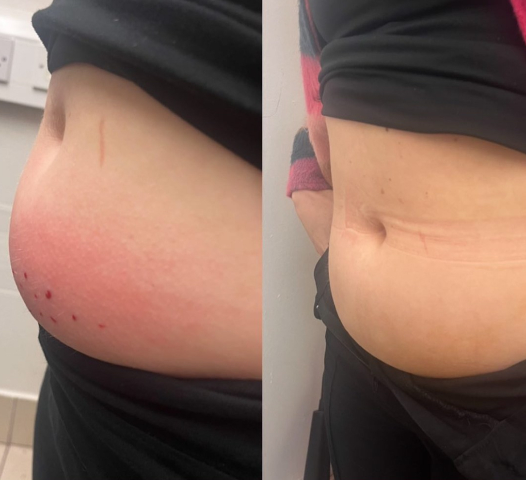 Stomach Fat Dissolving Results